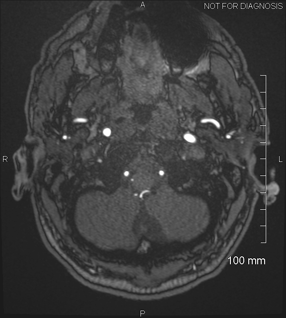 Anterior cerebral artery aneurysm (Radiopaedia 80683-94127 Axial MRA 11).jpg