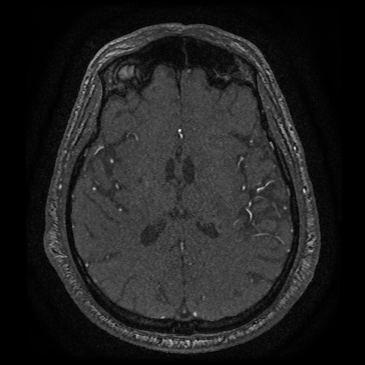 Anterior cerebral artery infarction (Radiopaedia 46794-51323 Axial MRA 122).jpg