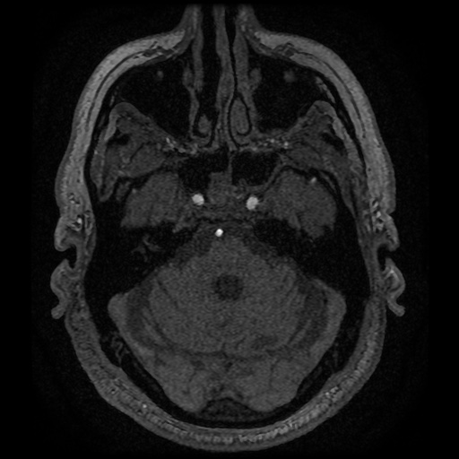 Anterior cerebral artery infarction (Radiopaedia 46794-51323 Axial MRA 33).jpg