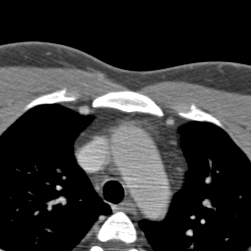 Anterior cerebral artery territory infarct (Radiopaedia 39327-41581 B 114).png
