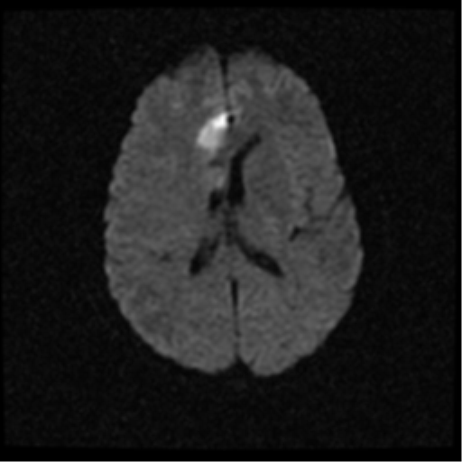 File:Anterior cerebral artery territory infarct (Radiopaedia 39327-41584 Axial DWI 15).png