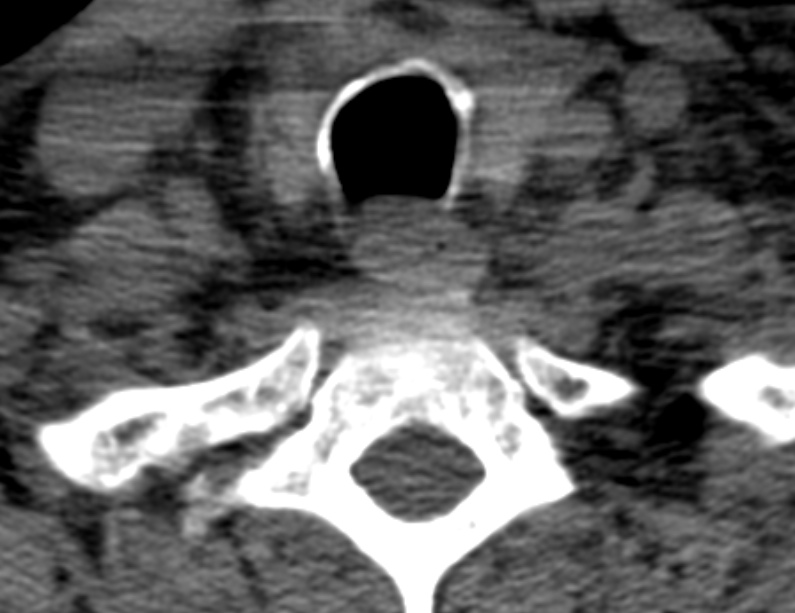 Anterior cervical postdiscectomy arthrodesis (Radiopaedia 32678-33646 Axial non-contrast 66).jpg