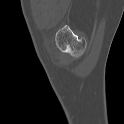 File:Anterior cruciate ligament avulsion fracture (Radiopaedia 58939-66194 Sagittal bone window 40).jpg