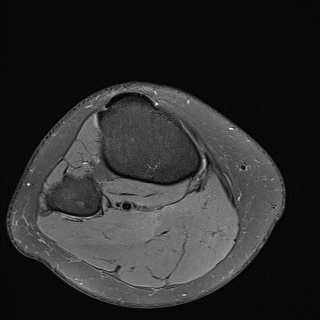 File:Anterior cruciate ligament rupture and posteromedial corner injury (Radiopaedia 67338-76723 Axial 32).jpg