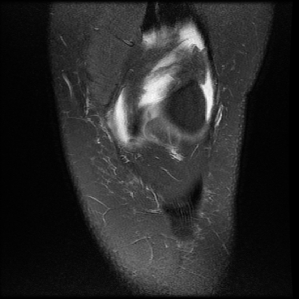 File:Anterior cruciate ligament tear, Wrisberg rip and bucket-handle tear of medial meniscus (Radiopaedia 75872-87266 Coronal PD fat sat 7).jpg