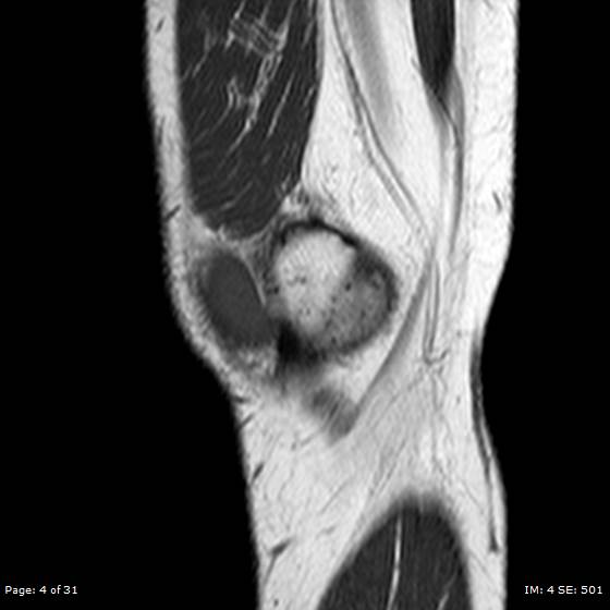 File:Anterior cruciate ligament tear (Radiopaedia 70783-80964 Sagittal T1 4).jpg