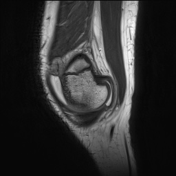 Anterior cruciate ligament tear - pediatric (Radiopaedia 62152-70260 Sagittal PD 29).jpg