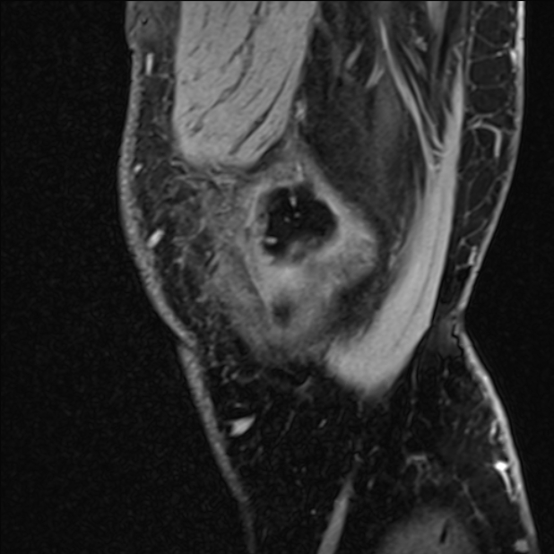 Anterior cruciate ligament tear - ramp lesion (Radiopaedia 71883-82322 Sagittal T1 vibe 127).jpg