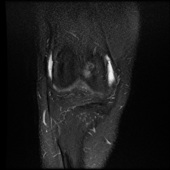 File:Anterior cruciate ligament tear with posteromedial corner injury, bucket-handle meniscal tear and chondral delamination (Radiopaedia 75501-86744 Coronal PD fat sat 7).jpg
