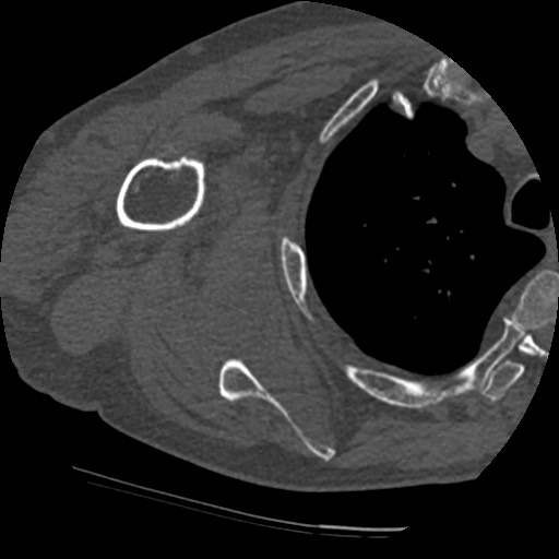 File:Anterior glenohumeral dislocation with Hill-Sachs lesion (Radiopaedia 62877-71249 Axial bone window 58).jpg