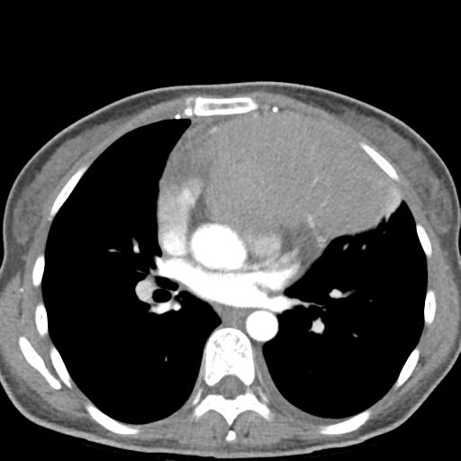 File:Anterior mediastinal lymphoma (Radiopaedia 29556-30061 C 30).jpg