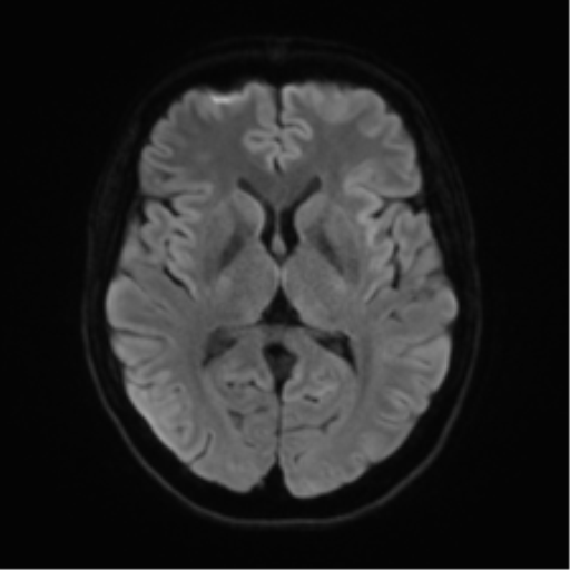 File:Anterior temporal lobe perivascular space (Radiopaedia 40946-43650 Axial DWI 41).png