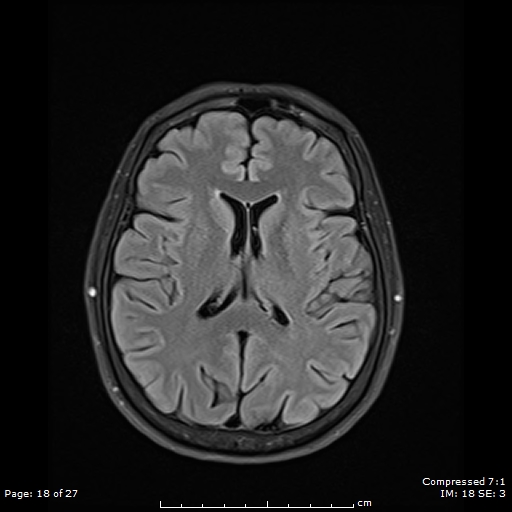 File:Anterior temporal lobe perivascular space (Radiopaedia 88283-104914 Axial FLAIR 18).jpg