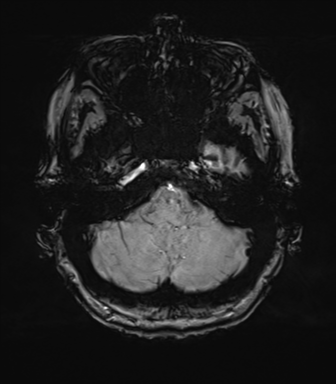 Anterior temporal pole cysts (Radiopaedia 46629-51102 Axial SWI 18).png