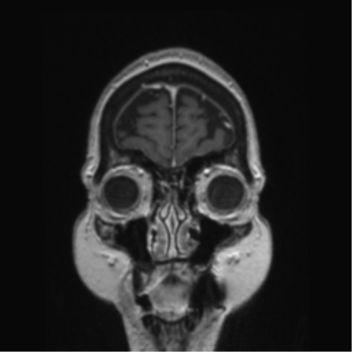 Anterior temporal pole cysts (Radiopaedia 46629-51102 Coronal T1 C+ 156).png