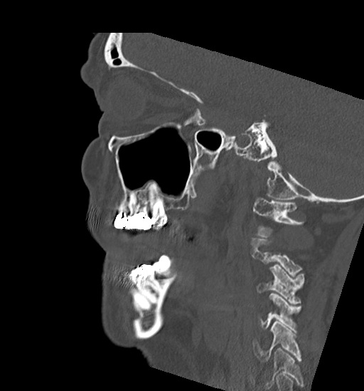Anterior temporomandibular joint dislocation (Radiopaedia 59430-66784 B 43).jpg