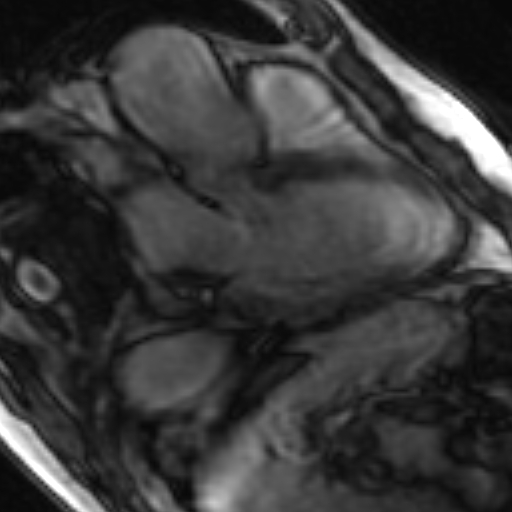 File:Anteroseptal hypokinesia after myocardial infarction (Radiopaedia 15978-15633 3 chamber view SSFE 17).jpg