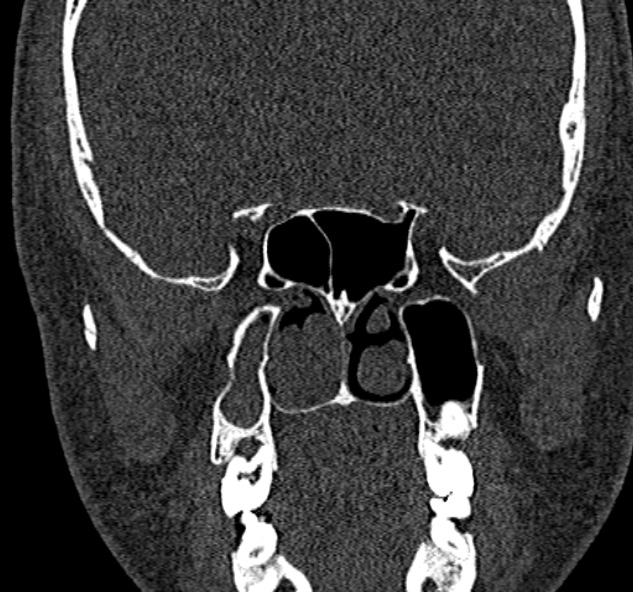 Antrochoanal polyp (Radiopaedia 30002-30554 Coronal bone window 52).jpg