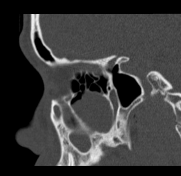 Antrochoanal polyp (Radiopaedia 33984-35202 Sagittal bone window 28).jpg