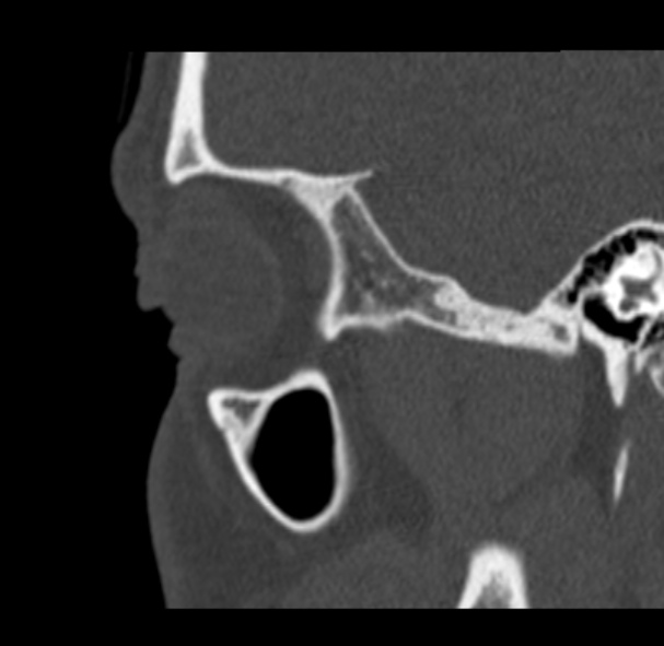 Antrochoanal polyp (Radiopaedia 33984-35202 Sagittal bone window 73).jpg