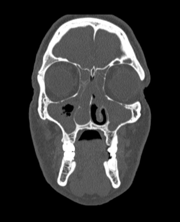 Antrochoanal polyp (Radiopaedia 79011-92169 Coronal bone window 60).jpg