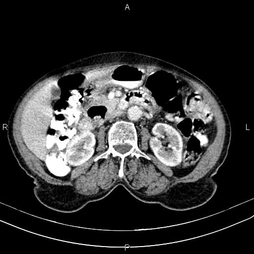 File:Aortic aneurysm and Lemmel syndrome (Radiopaedia 86499-102554 A 37).jpg