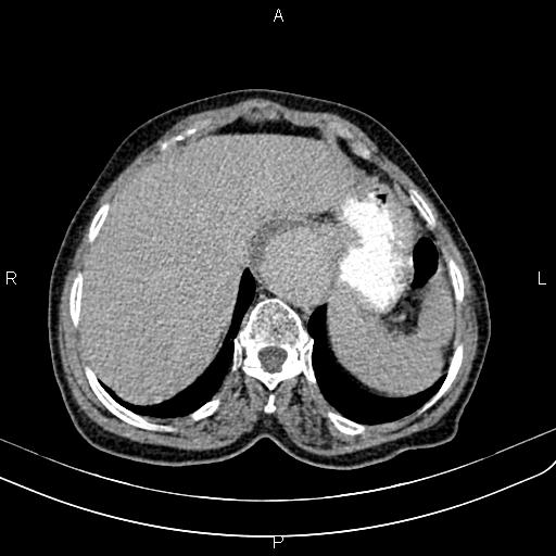 Aortic aneurysm and Lemmel syndrome (Radiopaedia 86499-102554 Axial C+ delayed 14).jpg
