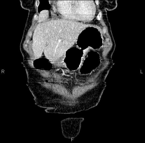 Aortic aneurysm and Lemmel syndrome (Radiopaedia 86499-102554 C 8).jpg