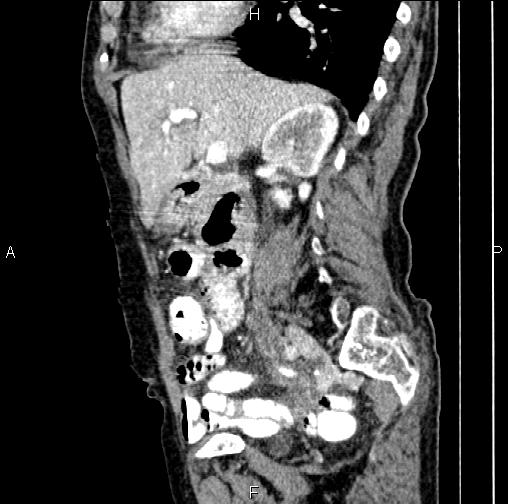 File:Aortic aneurysm and Lemmel syndrome (Radiopaedia 86499-102554 D 33).jpg
