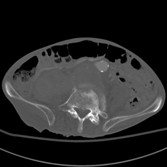 Aortic aneurysm with spinal destruction (Radiopaedia 42301-45410 Axial bone window 69).jpg
