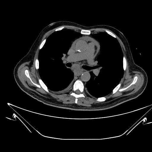 Aortic arch aneurysm (Radiopaedia 84109-99365 Axial non-contrast 129).jpg