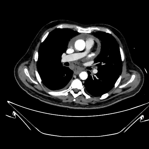 File:Aortic arch aneurysm (Radiopaedia 84109-99365 C 207).jpg