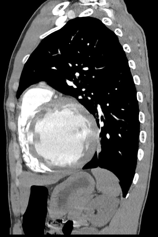Aortic coarctation with aneurysm (Radiopaedia 74818-85828 B 113).jpg