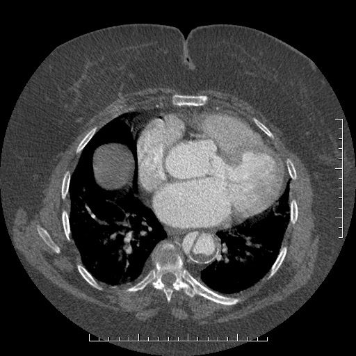 Aortic dissection- Stanford A (Radiopaedia 35729-37268 A 60).jpg