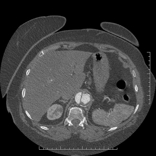 Aortic dissection- Stanford A (Radiopaedia 35729-37268 B 33).jpg
