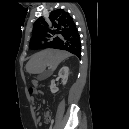 File:Aortic dissection- Stanford A (Radiopaedia 37759-39664 Sagittal C+ delayed 2).png