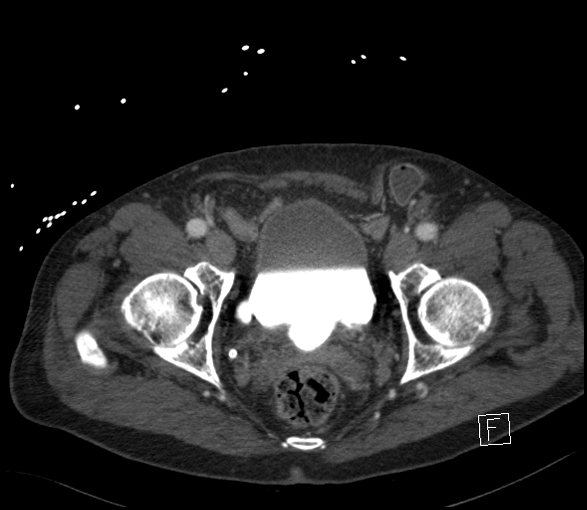 Aortic dissection (CTPA) (Radiopaedia 75506-86750 E 141).jpg