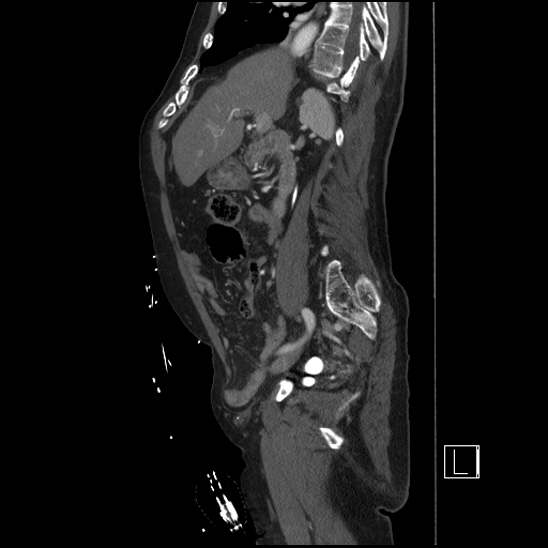 Aortic dissection (CTPA) (Radiopaedia 75506-86750 G 39).jpg