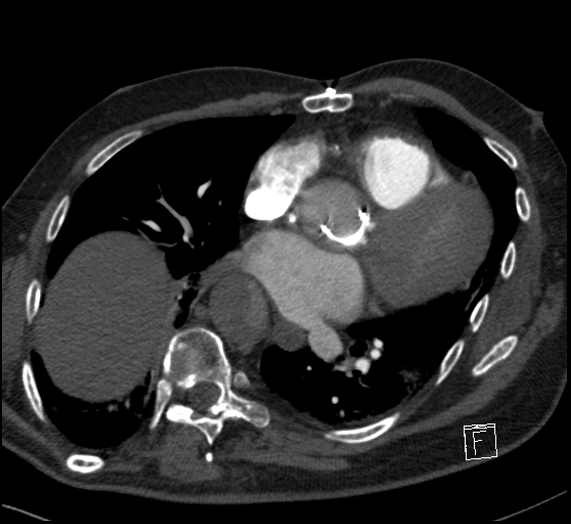 File:Aortic dissection (CTPA) (Radiopaedia 75506-86751 Axial C+ CTPA 84).jpg