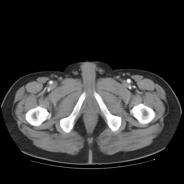 Aortic dissection (Radiopaedia 44411-48061 C 61).jpg
