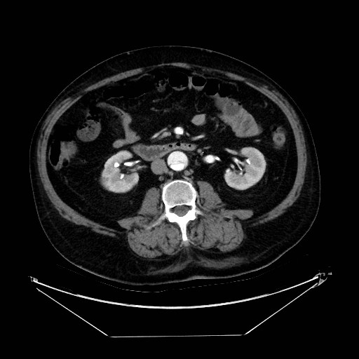 Aortic dissection (Radiopaedia 62562-71000 A 69).jpg