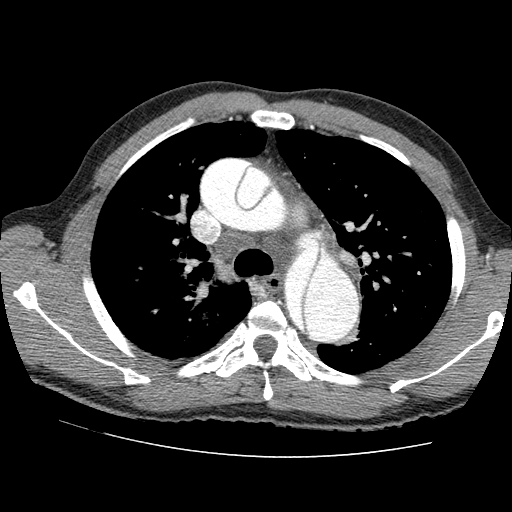 File:Aortic dissection - Stanford A -DeBakey I (Radiopaedia 28339-28587 B 22).jpg