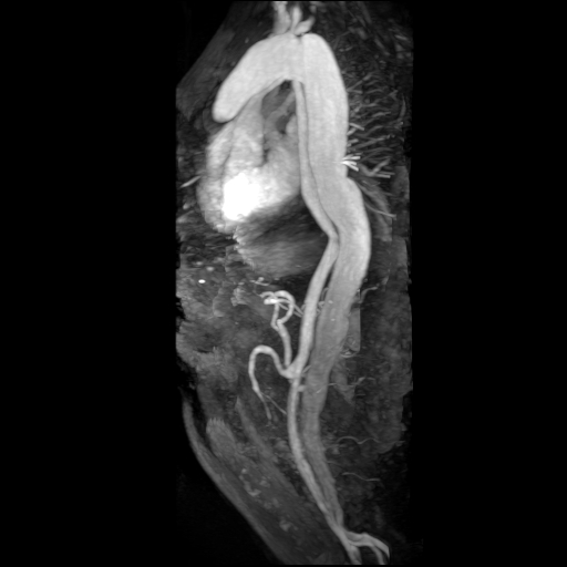 File:Aortic dissection - Stanford A - DeBakey I (Radiopaedia 23469-23551 MRA 20).jpg