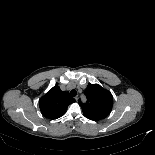 Aortic dissection - Stanford type A (Radiopaedia 83418-98500 Axial non-contrast 7).jpg