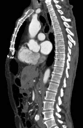 File:Aortic dissection - Stanford type B (Radiopaedia 73648-84437 C 80).jpg