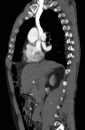 File:Aortic dissection - Stanford type B (Radiopaedia 73648-84437 C 93).jpg