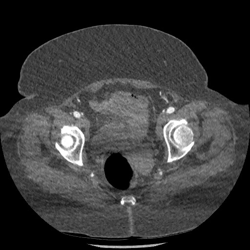 Aortic dissection - Stanford type B (Radiopaedia 88281-104910 A 154).jpg