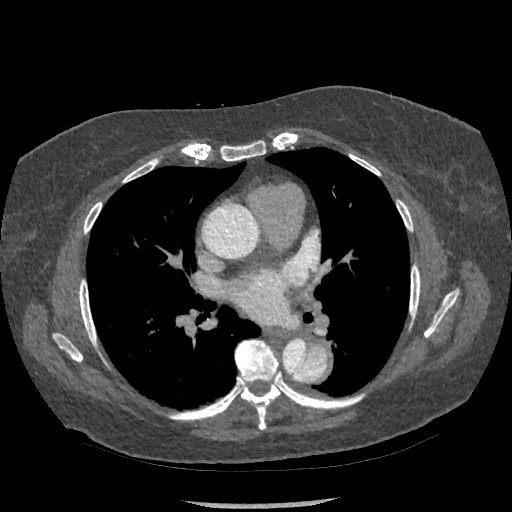 File:Aortic dissection - Stanford type B (Radiopaedia 88281-104910 A 43).jpg