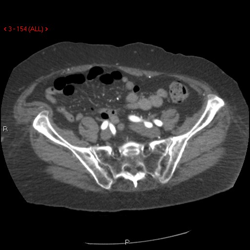 File:Aortic intramural hematoma (Radiopaedia 27746-28001 A 154).jpg