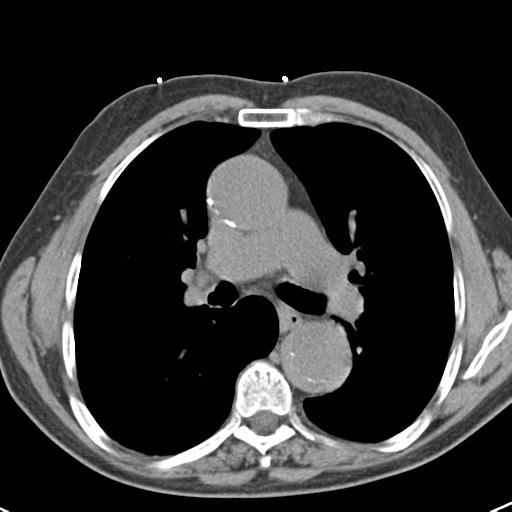 Aortic intramural hematoma (Radiopaedia 31139-31838 Axial non-contrast 25).jpg